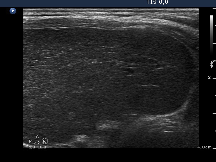 Right lobe, longitudinal scan