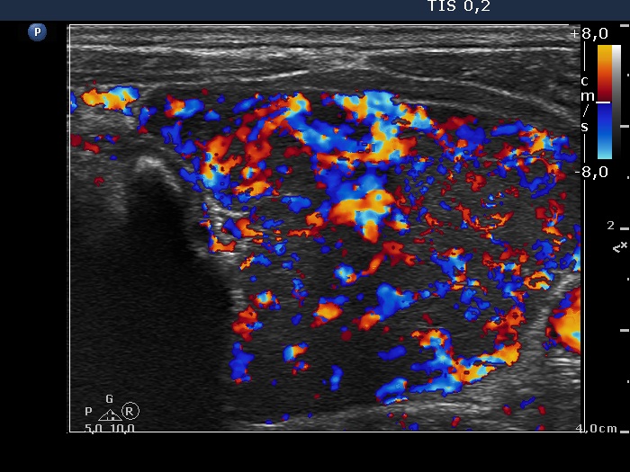 Right lobe, longitudinal scan