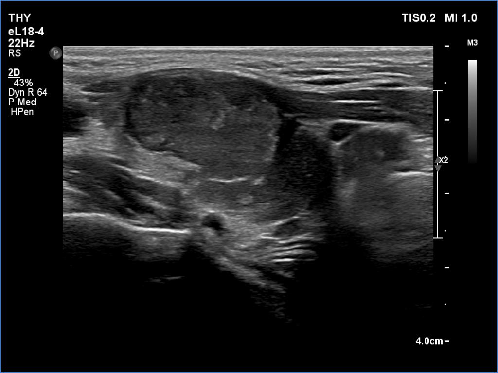 Right lobe, longitudinal scan