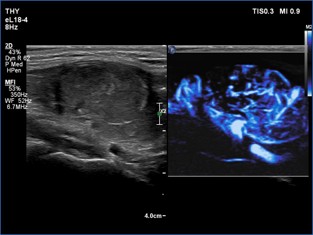 Right lobe, longitudinal scan