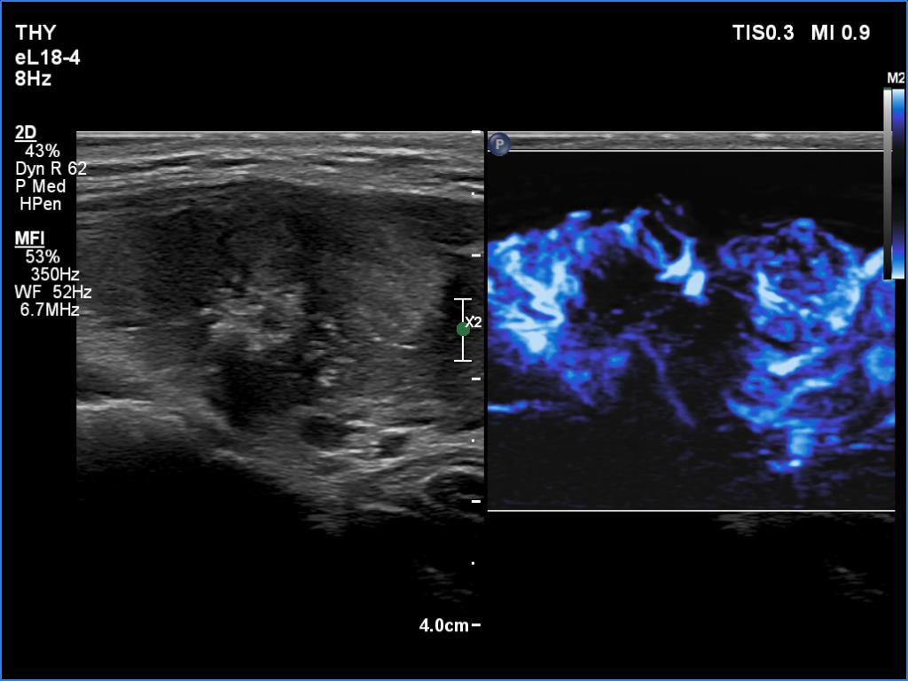 Right lobe, longitudinal scan