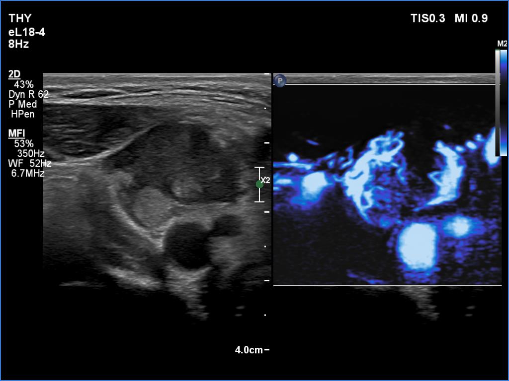 Right lobe, longitudinal scan