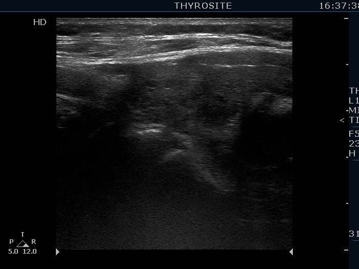 Right lobe, longitudinal scan