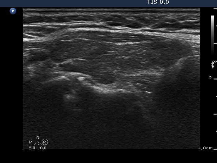 Right lobe, longitudinal scan