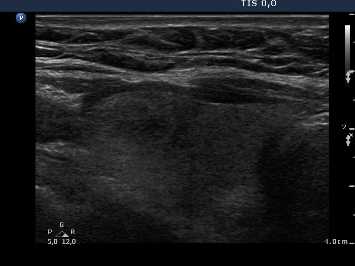 Right lobe, horizontal view