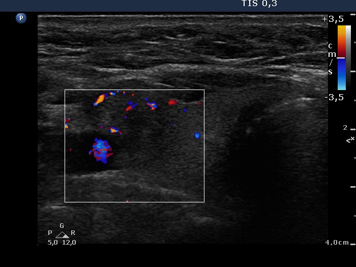 Right lobe, horizontal view
