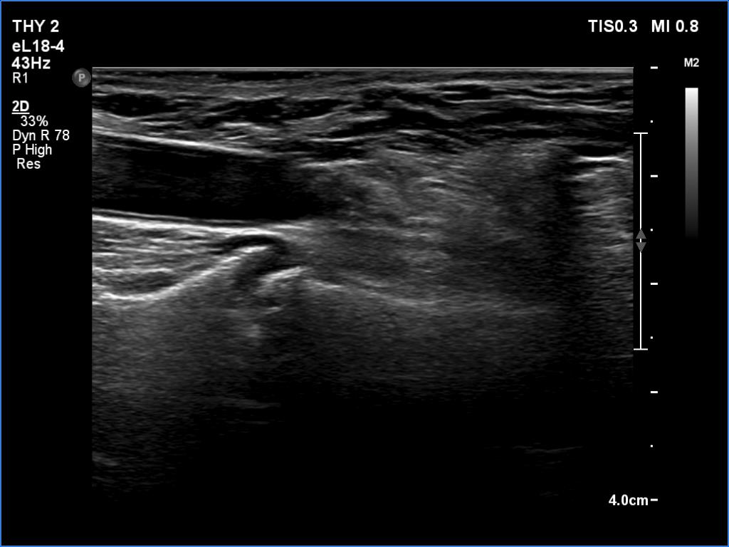 Right lobe, longitudinal scan