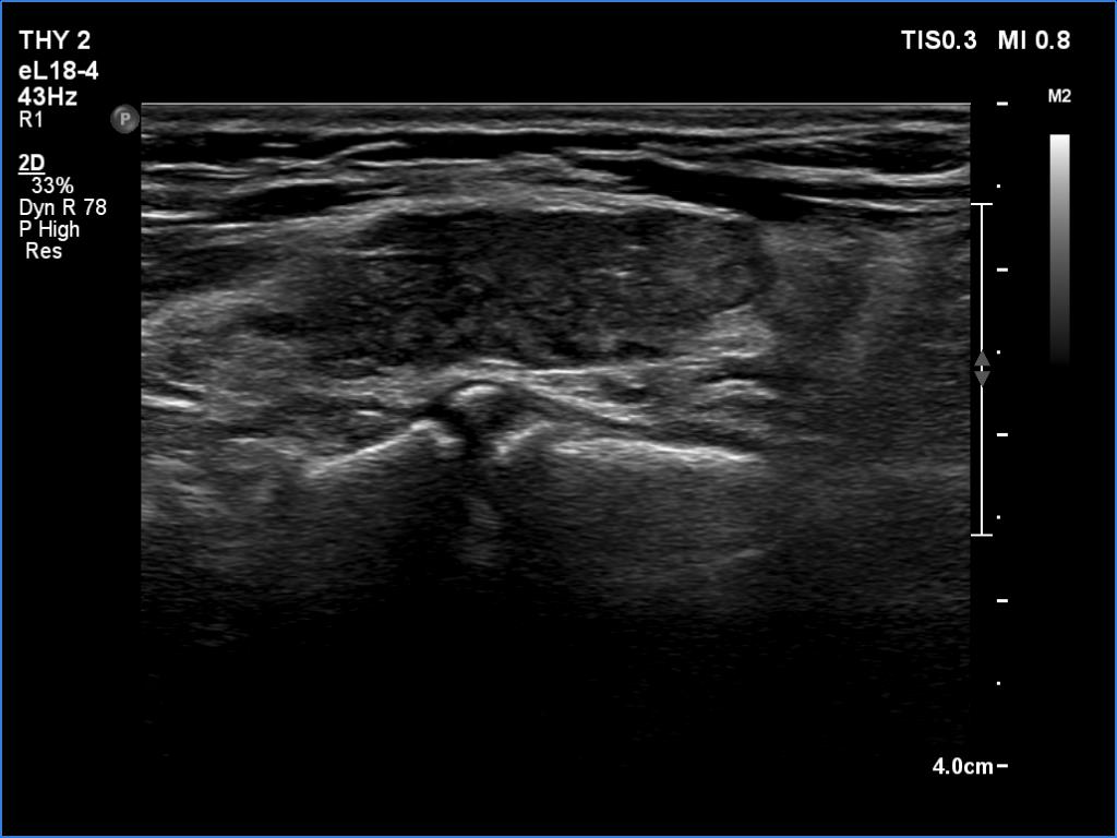 Right lobe, longitudinal scan