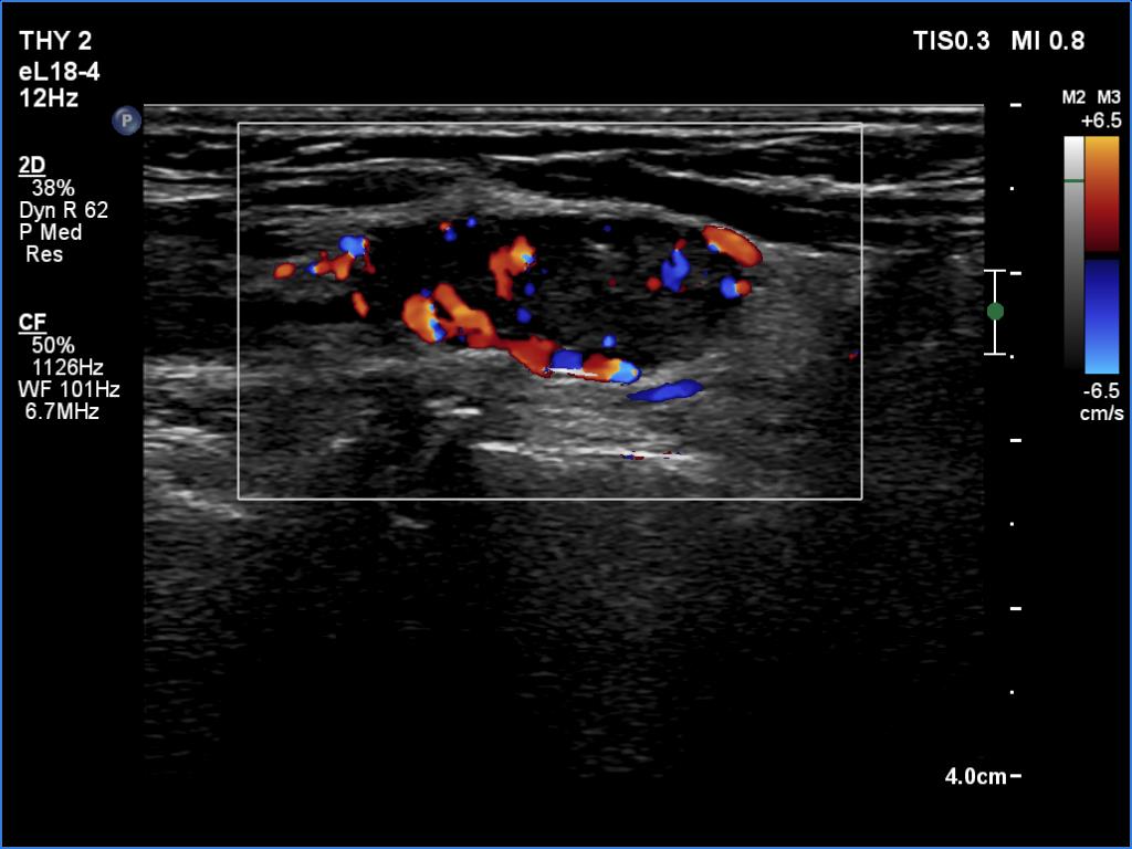 Right lobe, longitudinal scan