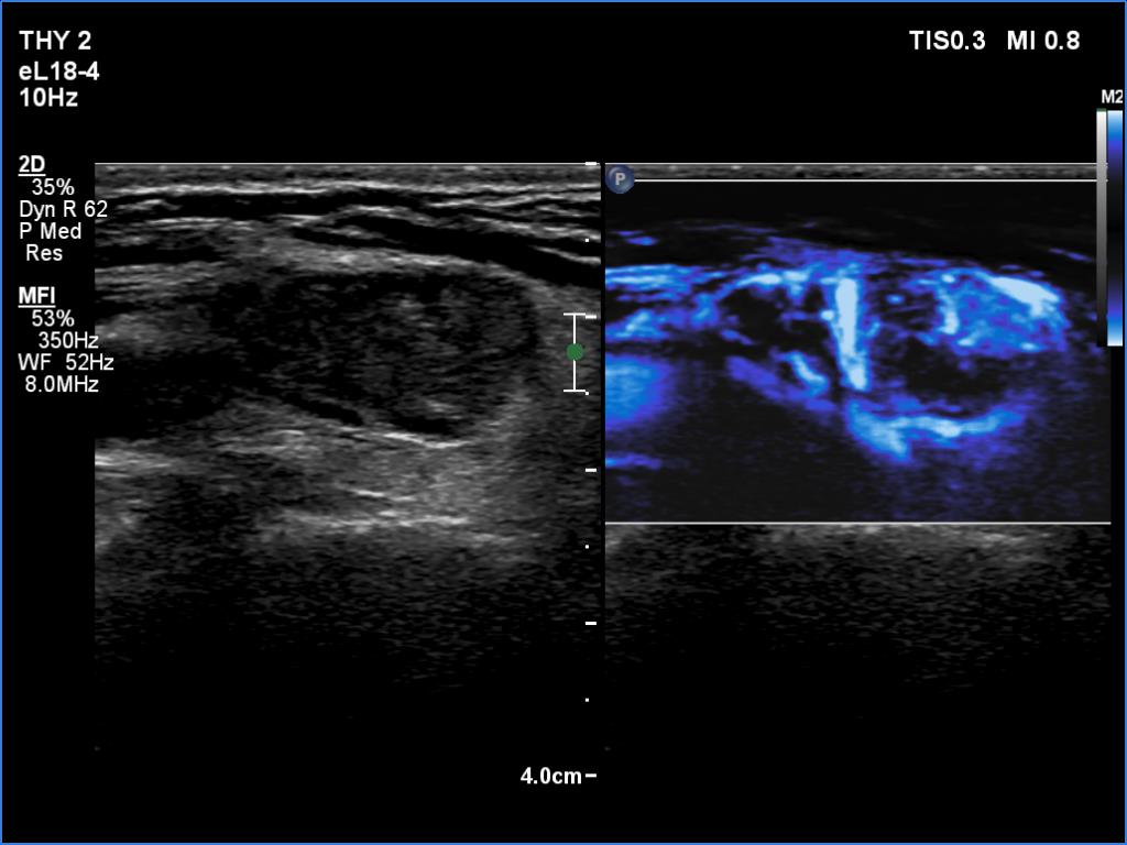 Right lobe, longitudinal scan