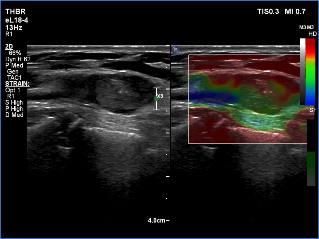 Right lobe, longitudinal scan