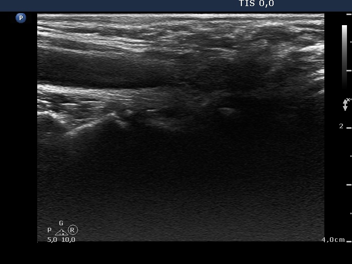 Right lobe, longitudinal scan