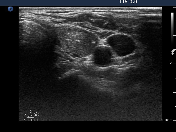 Right lobe, longitudinal scan