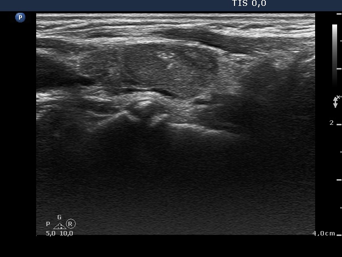 Right lobe, longitudinal scan