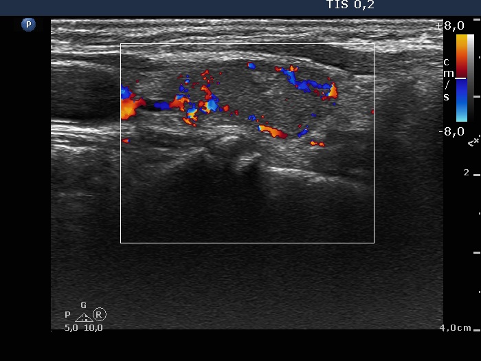 Right lobe, longitudinal scan
