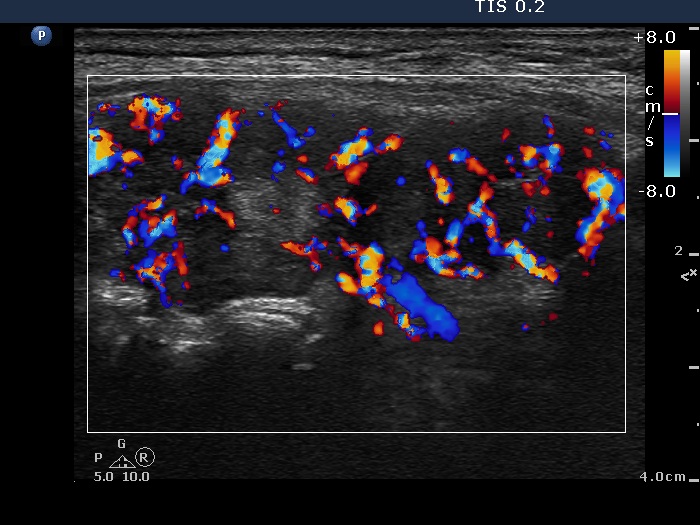Right lobe, longitudinal scan
