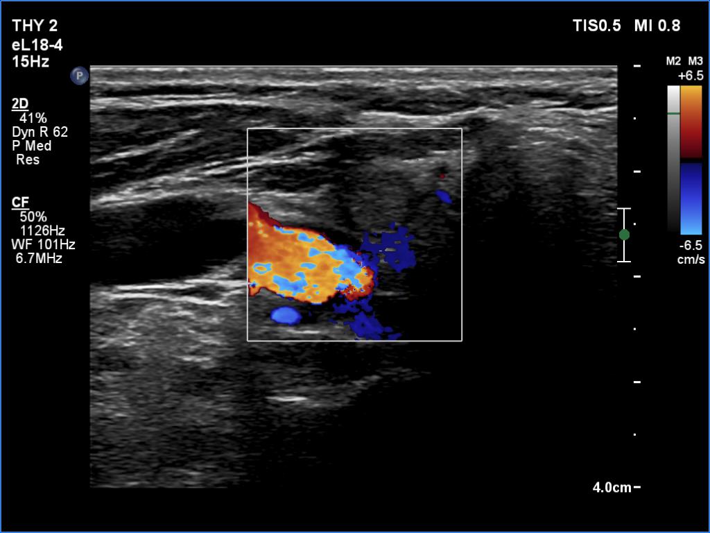 Right lobe, longitudinal scan