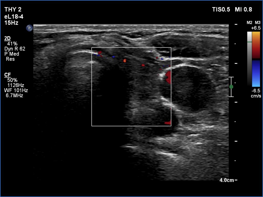Right lobe, longitudinal scan