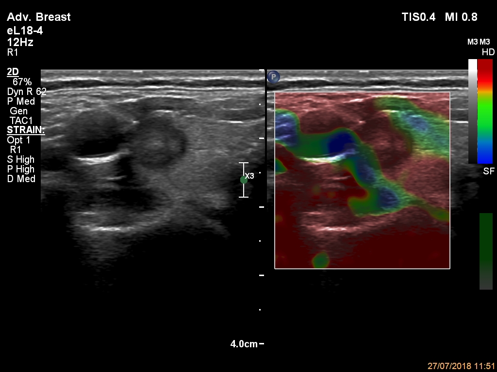 Right lobe, longitudinal scan