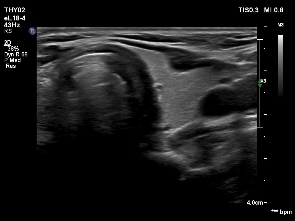 Right lobe, longitudinal scan