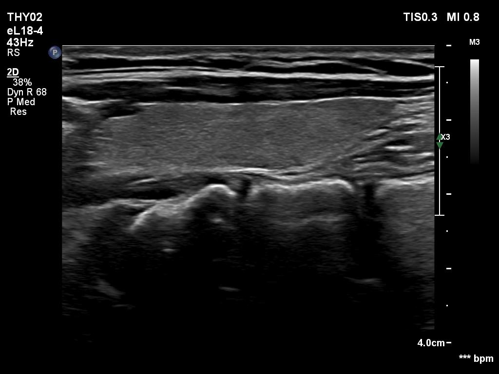 Right lobe, longitudinal scan
