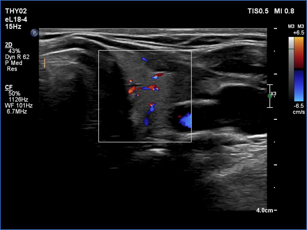 Right lobe, longitudinal scan