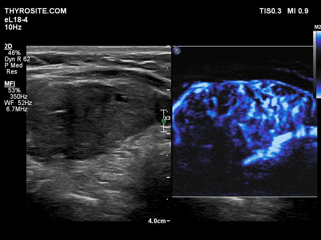 Right lobe, longitudinal scan