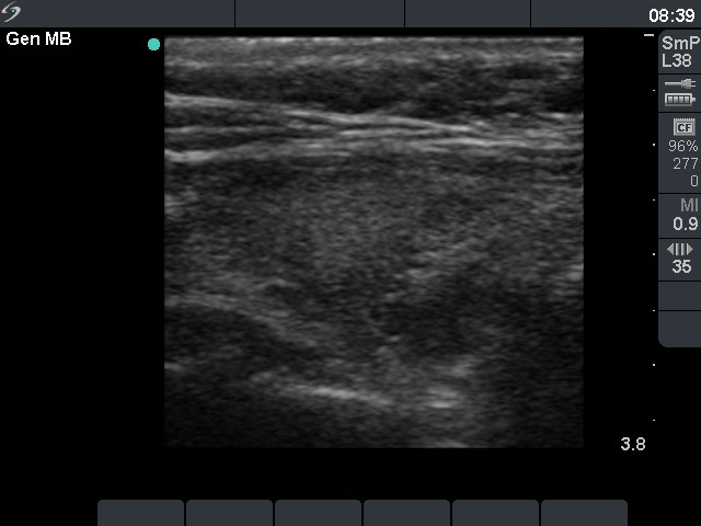 Right lobe, longitudinal scan