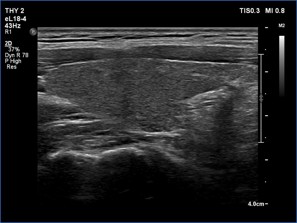 Right lobe, longitudinal scan