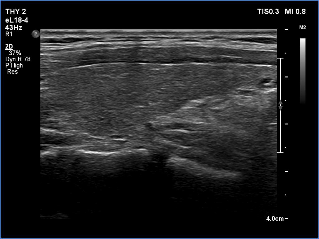Right lobe, longitudinal scan