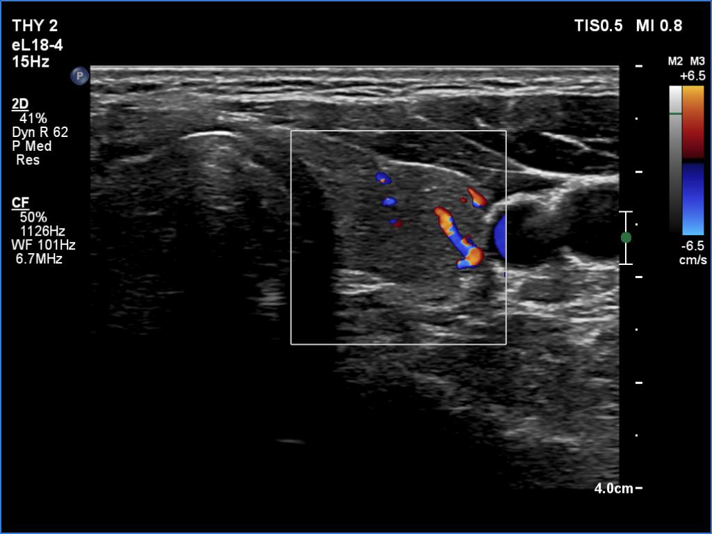 Right lobe, longitudinal scan