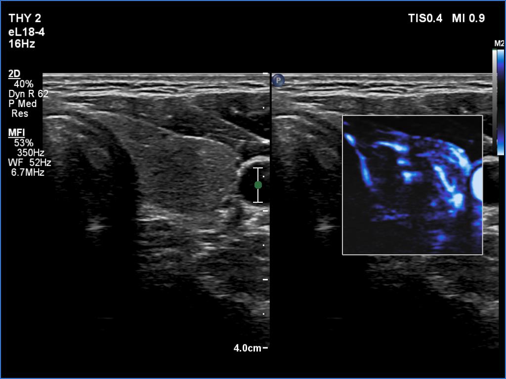 Right lobe, longitudinal scan