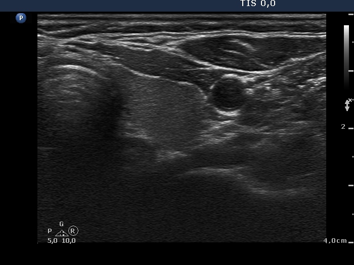 Right lobe, longitudinal scan