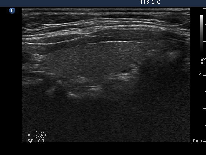 Right lobe, longitudinal scan