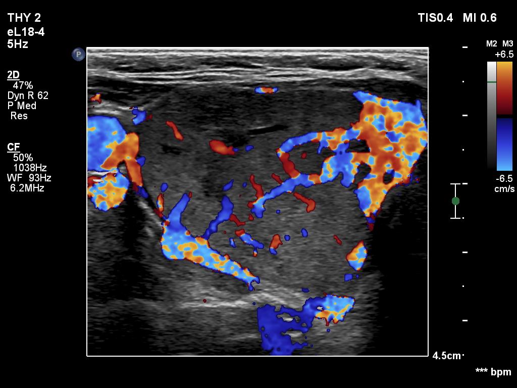 Right lobe, longitudinal scan