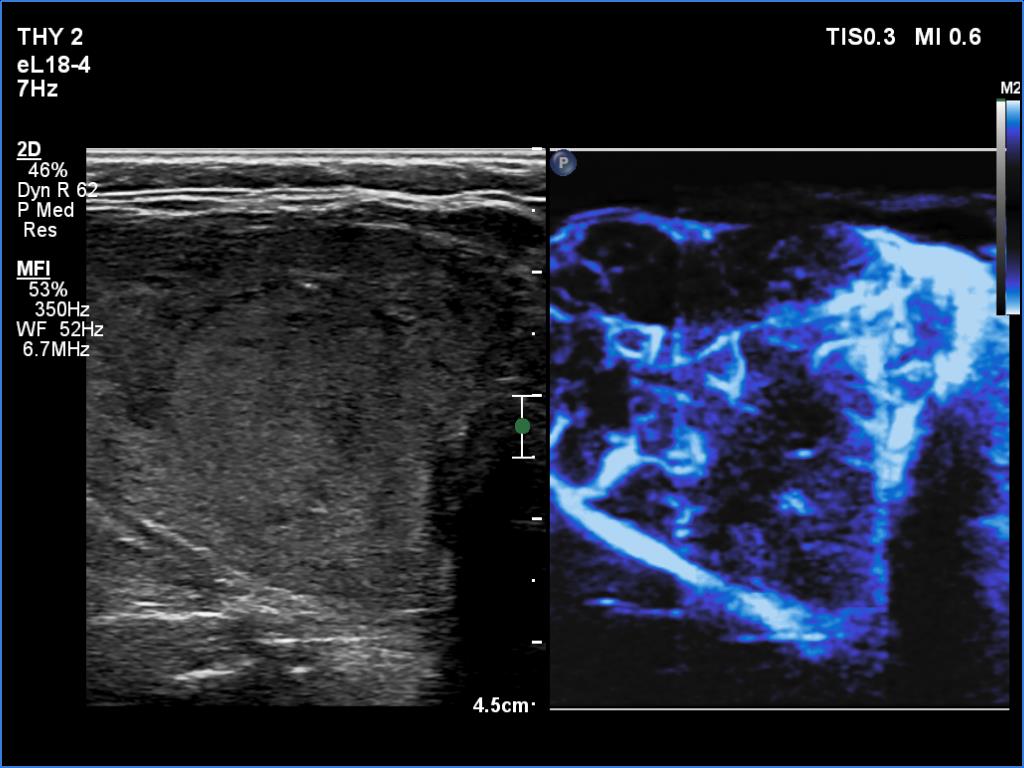 Right lobe, longitudinal scan