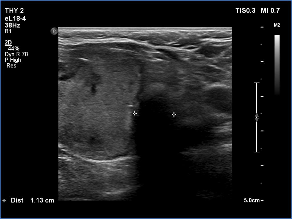 Right lobe, longitudinal scan