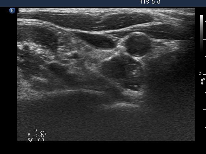 Right lobe, longitudinal scan