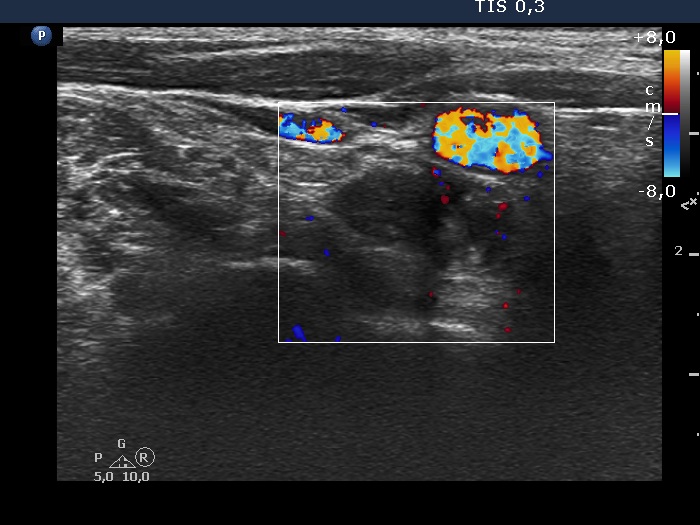 Right lobe, longitudinal scan