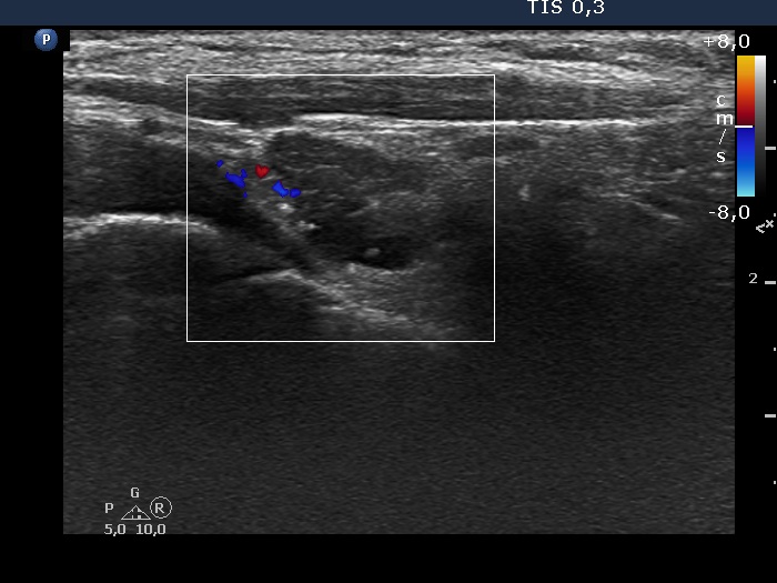 Right lobe, longitudinal scan