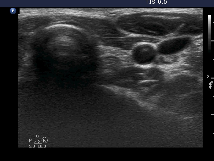 Right lobe, longitudinal scan