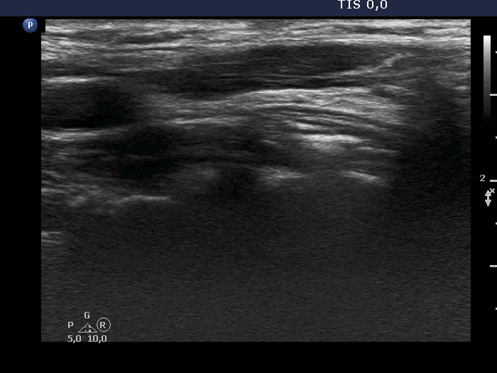 Right lobe, longitudinal scan