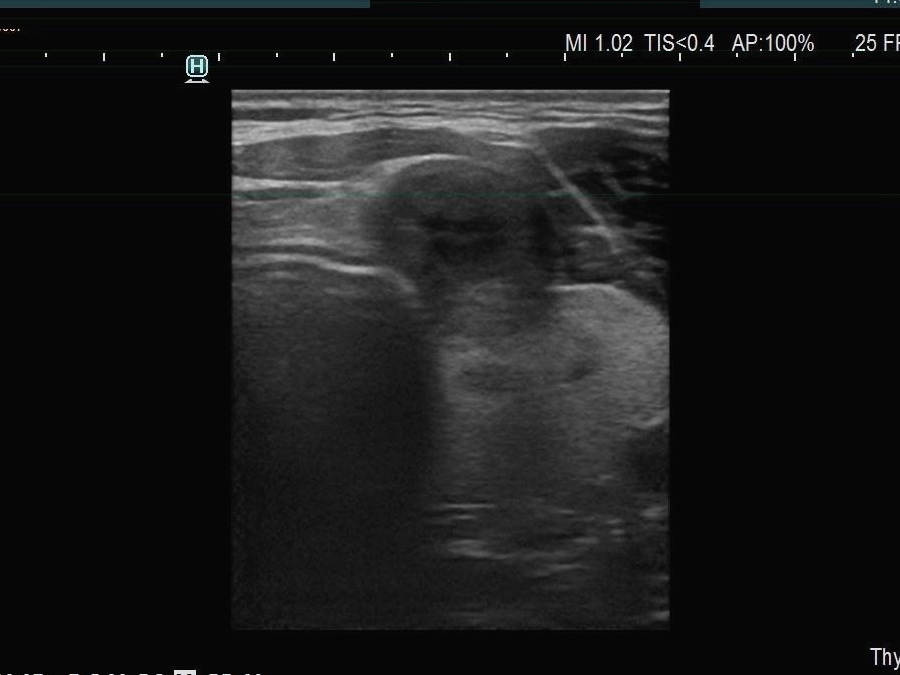 Right lobe, longitudinal scan
