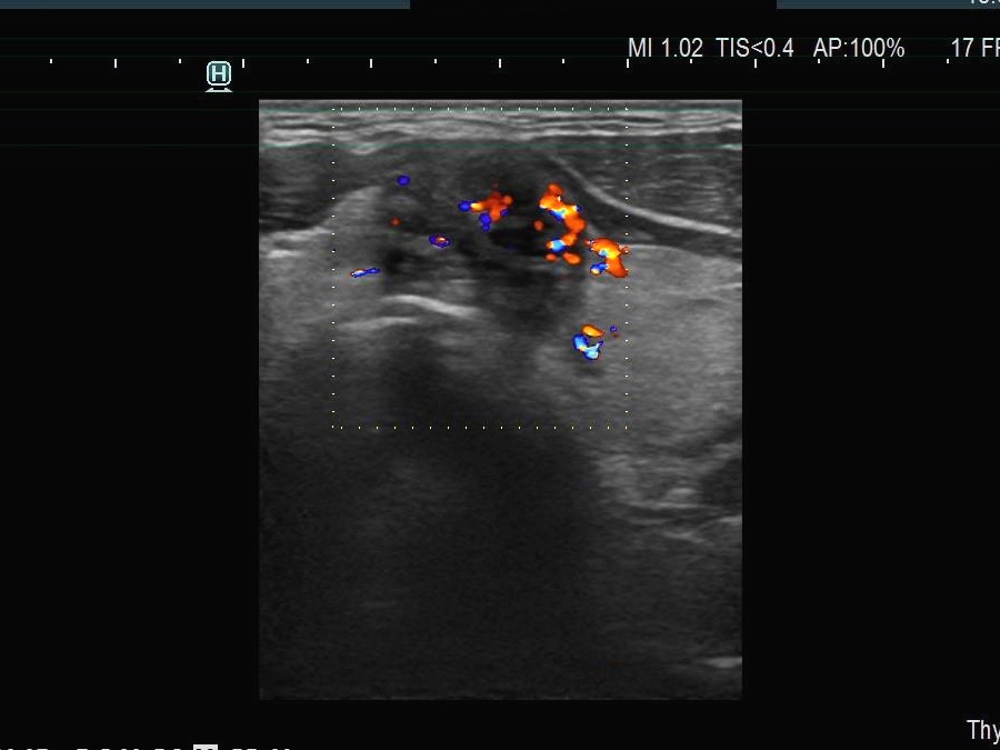 Right lobe, longitudinal scan