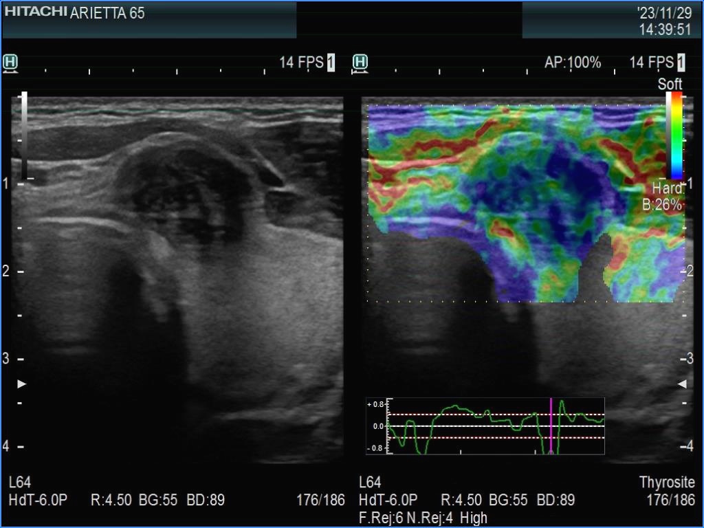 Right lobe, longitudinal scan