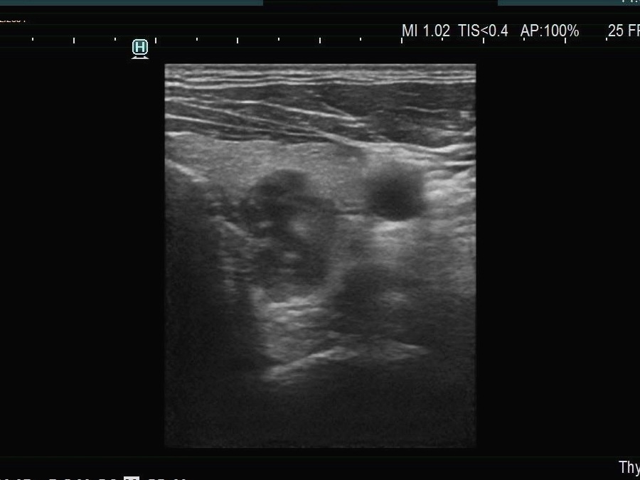 Right lobe, longitudinal scan