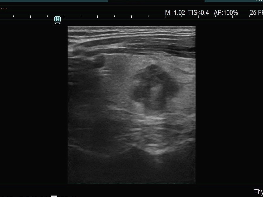 Right lobe, longitudinal scan