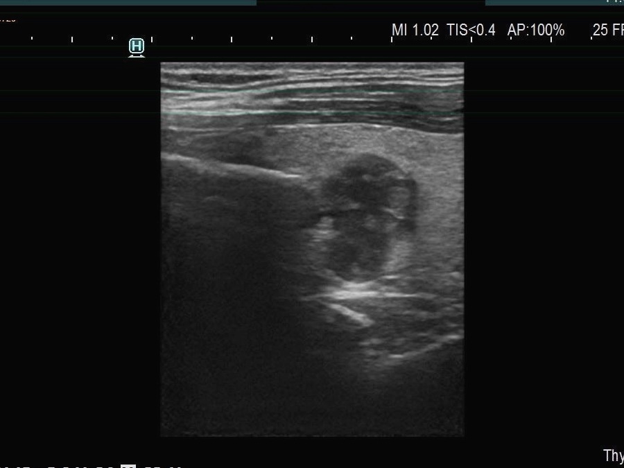 Right lobe, longitudinal scan