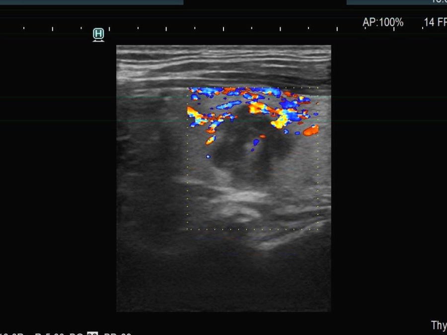 Right lobe, longitudinal scan