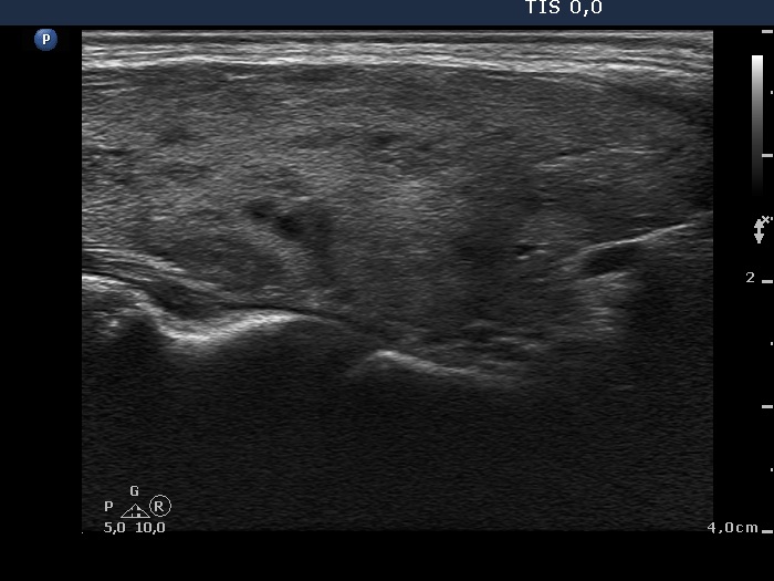 Right lobe, longitudinal scan